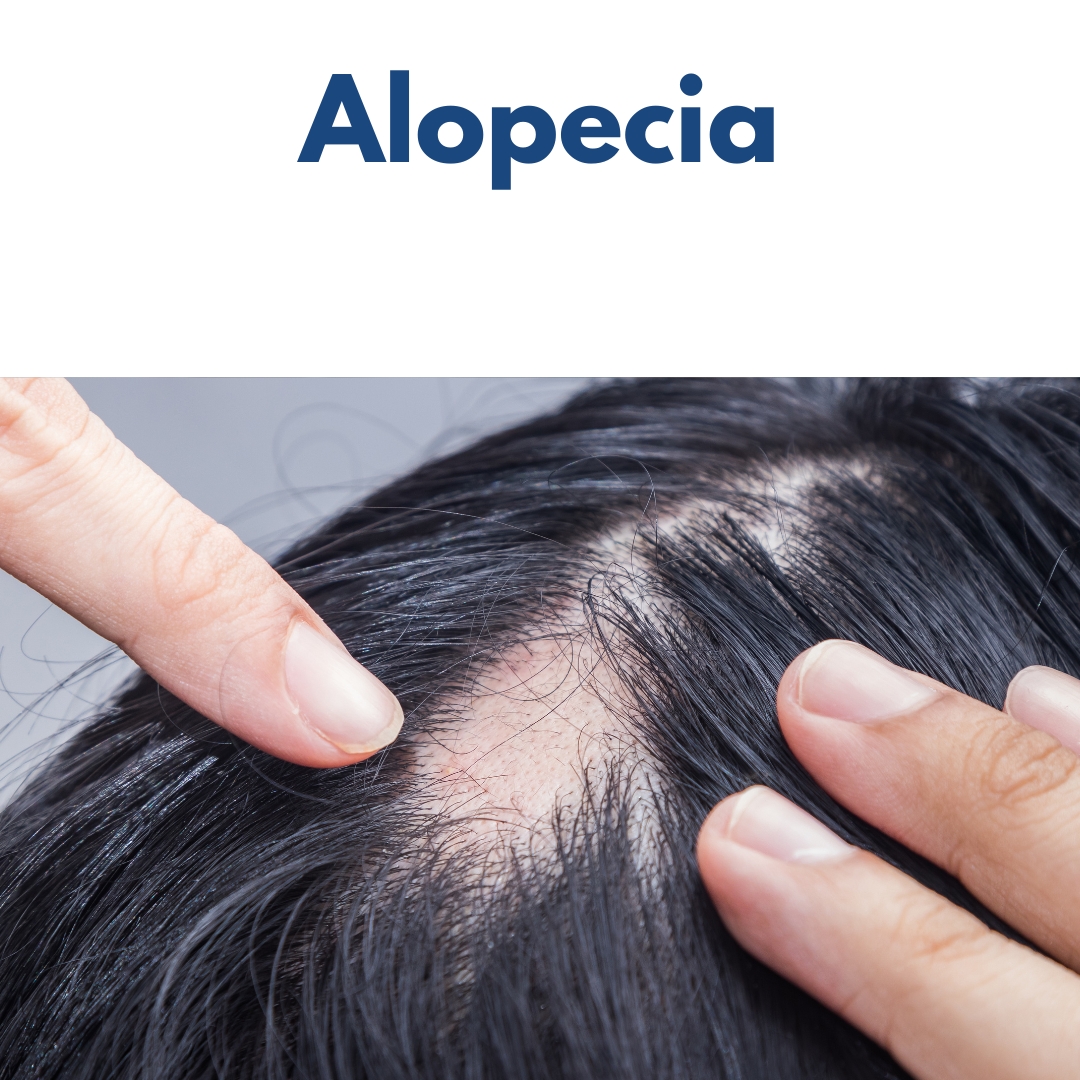 Alopecia