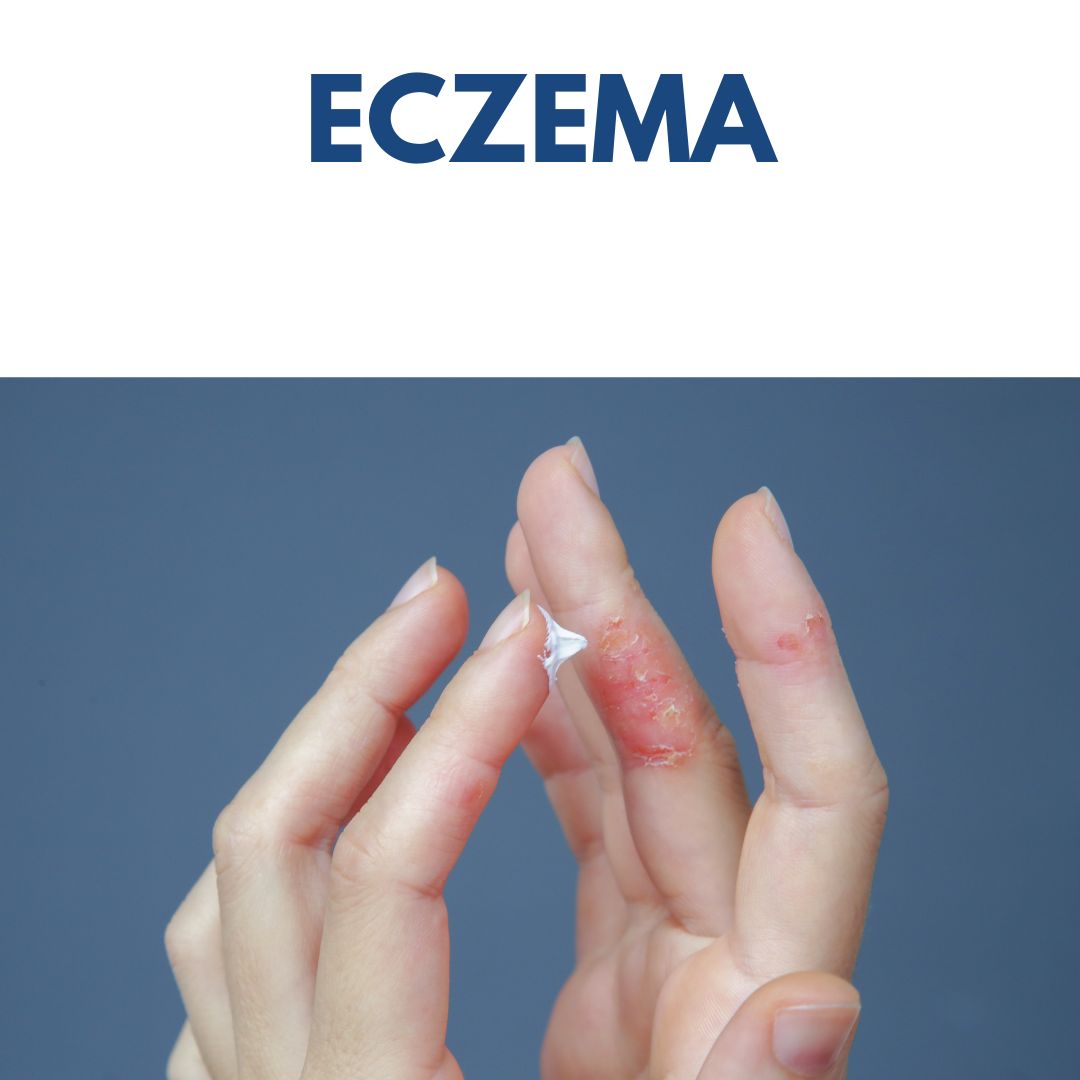 ECZEMA